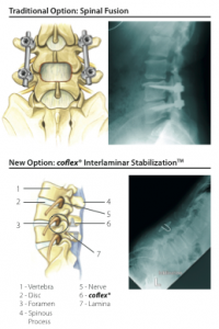 Coflex non-fusion spinal stenosis treatment